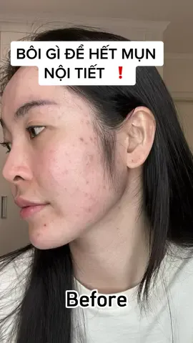 Mình bôi gì để tiễn MỤN NỘI TIẾT ⁉️ #goclamdep #BeautyReview #skincare #munnoitiet #dadaumun 