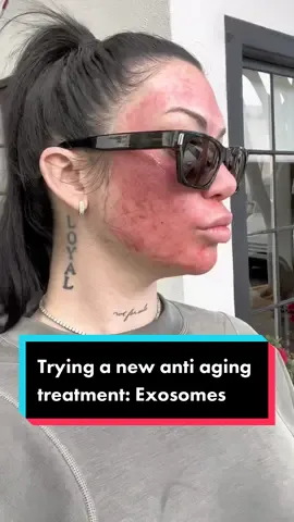 #exosomes #microneedling #antiaging 
