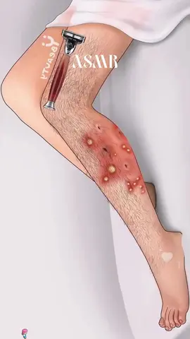 Remove the hair and pustules on the leg#fyp #foryou #health #animation #asmr 