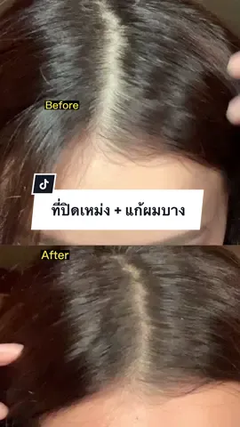 ไอเท่มสำหรับสาวผมบาง (แบบอิชั้น🥲)ช่วยปิดเหม่ง+แก้ผมบาง อันนี้ของ odbo ถูกและดี ✨  #fyp #hairtok #korean #pangpanghairshadow #hairhacks #TikTokBeauty #beautygadgets #ปิดเหม่ง #ผมบาง #beautyhacks #koreanhairstyle 