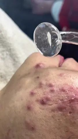 What do u know about high frequency?🔥#highfrequency #pimples #pimplespopping #blackheadsremoving