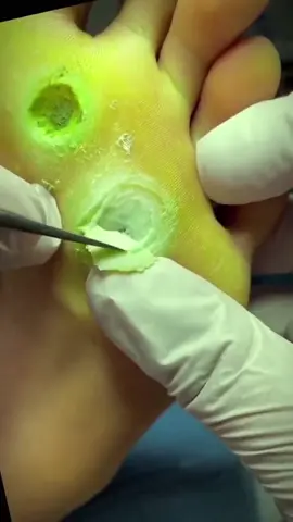 #footpain #fyp #viralvideo #satisfying #callusremoval #painful #podiatry #satisfyingvideo #myfootarekillingme #callus #trendingvideo #calluses #healthyfeetpodiatry #pedicure #crackedfeet @footworksrelaxingvideos 
