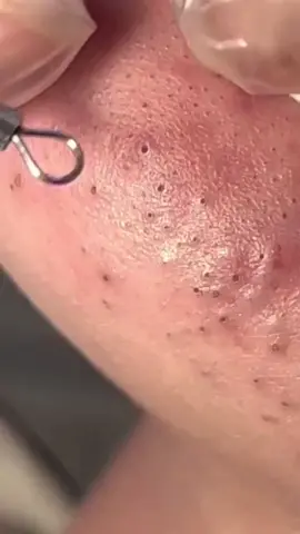 Blackhead removal #pimple #acne #pimples #blackheads #pimplepopping #skincare #blackhead #pimplepopper #whiteheads #pimplepoppers #whitehead #blackheadextraction #blackheadremoval #cyst #pimplepop #drpimplepopper #pimplesremover #zit #pores #skin #whiteheadextraction #drsandralee #beauty #acnetreatment #cystremoval #zits #whiteheadremoval #jerawat #skincareroutine #pimpleremover