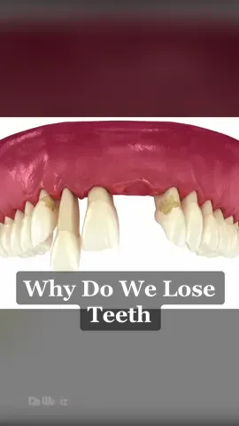 Why Do We Lose Teeth, Periodontitis Explained #3d #animation #periodontitis #teeth #gums 
