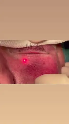 🇩🇪Unterlidstraffung ohne Schnitt 🦢 Stellt eure Fragen per DM 📨 🇬🇧 Lower blepharoplasty without surgery 🦢 Send your questions via DM 📨 Video & Result: @drfatemi  #ehrenarzt #beautydoc #schönheitschirurgie #co2laser 