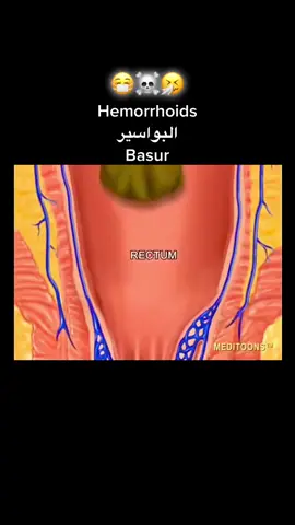 Wotel gaaw 772908755 #hemorrhoids #ballonements #colopathiefonctionnelle #pourtoi #tiktoksenegalais 