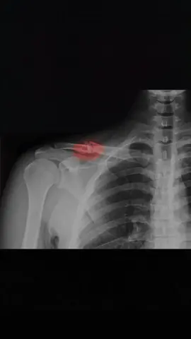 patah tulang selangka😞 #sadvibes #fyp 