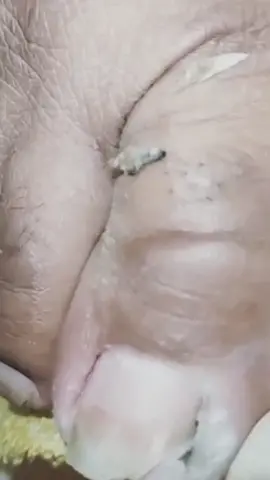 #ingrowntoenail #ingrownnail #ingrown #ingrowntoenailremoval #footpain #fyp #ingrowntoenailsurgery #stubborn #granuloma  #satisfying #relaxing #viralvideo @footworksrelaxingvideos 