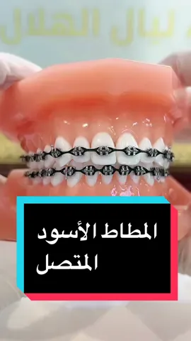 Replying to @.aruam..2  أكثر لون يتم طلبه مني 🖤 #orthodontics #orthodontist #jeddah #saudiarabia #jeddah_clinics #دكتورة_ليال_الهلال #ابتسامة_النجوم_التحلية #دكتورة_تقويم_أسنان #جدة #عيادات_جدة #مطاط_التقويم 