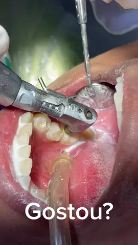 A Profilaxia Dental, deve ser feita de 06/06 meses, é um procedimento indolor e muito importante. Agende já a sua consulta, com a Dra. Edna Pinto o seu sorriso “Brilha mais “🦷✨  Contacto:924185018 #😍 #foryou #sorri #sorria #sorrisodecanto #dentista #dentistaentiktok #esteticadental #sorrisomaroto #odontologia #odontopediatria #cancer #amor #angolatiktok #angola🇦🇴portugal🇵🇹brasil🇧🇷 #mozambique🇲🇿 #restauracaodentaria #consultorio #paravoce #draednapinto 