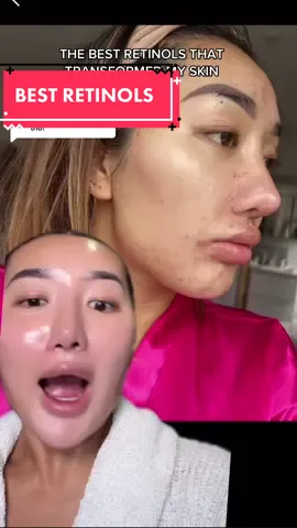 Replying to @Jojo🇸🇦 the best retinol skincare that transformed my skin! Products mentioned; @Dr. Dennis Gross texture renewal serum, @CeraVe resurfacing serum @medik8.care Retinal 3 #retinol #skincare #skincareforacne #acneskin #acneskincare #skincaretutorial #skincaretransformation #skincaretiktok 