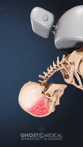 #whiplash occurs when your head is rapidly thrown backward and then forward subjecting the cervical spine to extreme forces and injuries. This motion can injure bones in the spine, disks between the bones, ligaments, muscles, nerves and other tissues of the neck. Patient Education collaboration piece with SpineHealth  #howthingswork #medicaltiktok #interestingfacts #awareness 
