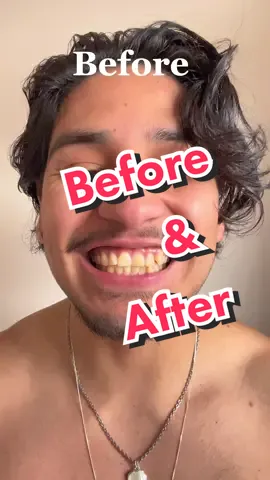The results are crazy! Tag us in your results #smile #mysmile #teeth #tiktokmademebuyit #badteeth #niceteeth #teethwhitening