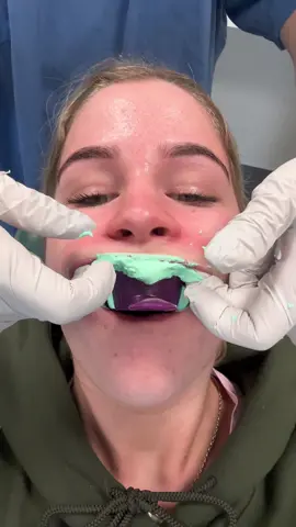 Ifykyk… moulds again to see if im ready, wilk find out at next appt in 5 weeks  #jawsurgery #underbite #braces #moulds #dental #dentist #nz #dentis #1111 #underbitecheck #doublejawsurgery #fyp #foryou #viral #tiktok #trending 