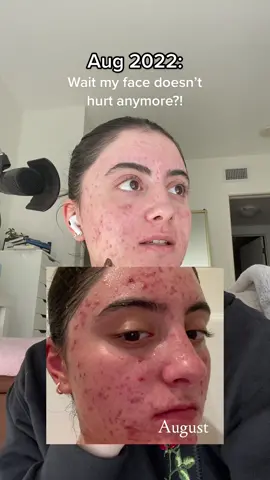 This trend is so wholesome to me 🥹 I love it #acnejourney #skinjourney 