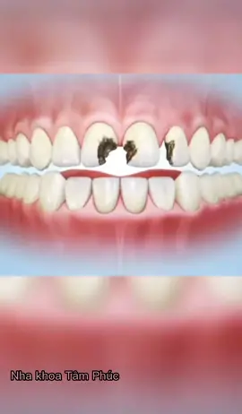 Quy trình dán sứ Veneer diễn ra như thế nào?  #xuhuong 