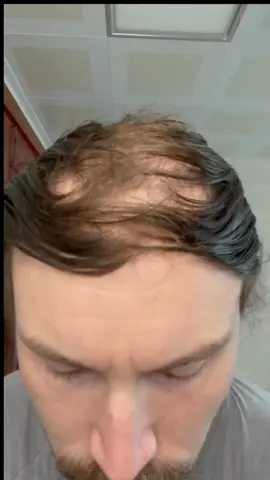 Bald spot no more? #baldcafe #balding #malepatternbaldness #coverup 