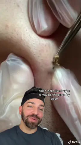 Rare find #poreofwiner #dermdoctor #pimplepopper 