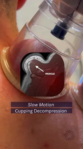 Myofascial Cupping Decompression: ⭕️Myofascial cupping decompression involves placing suction cups on the skin to create negative pressure, which lifts and separates the layers of fascia and muscle tissue, improving tissue mobility and increasing blood flow. ⭕️This technique can be used to treat a range of conditions, including musculoskeletal pain, tightness, and stiffness, as well as sports injuries and post-workout recovery. ⭕️Myofascial cupping decompression can be performed by trained healthcare professionals or physical therapists, and it is generally safe and well-tolerated, with few reported side effects #cuppingtherapy #myofascialcupping #drycupping #wetcupping #cuppingmassage #musclerelease #painrelief #musclesoreness #injuryrecovery #sportstherapy #drkyleross #alternativetherapy #holistichealth #wellness #SelfCare #bodywork #acupuncture #traditionalchinesemedicine #healthylifestyle #naturalhealing