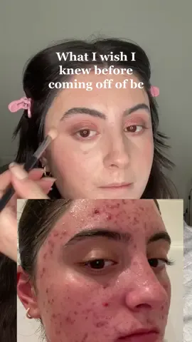 Coming off of birth control was just as hard as being on it but I’m so happy I got off and will never go on again.  Check out Eps 4 of @LoudTalk where me and Sophia talk about our experiences with hormonal birth control  #hormonalimbalance #hormonalbirthcontrol #birthcontrolproblems #hormonalacne #acnejourney #birthcontrolpill 