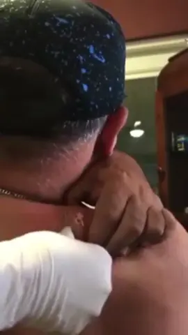 Massive pop  #pimple #acne #pimples #blackheads #pimplepopping #skincare #blackhead #pimplepopper #whiteheads #pimplepoppers #whitehead #blackheadextraction #blackheadremoval #cyst #pimplepop #drpimplepopper #pimplesremover #zit #pores #skin #whiteheadextraction #drsandralee #beauty #acnetreatment #cystremoval #zits #whiteheadremoval #jerawat #skincareroutine #pimpleremover