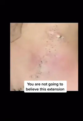 BACK OF THE NECK. 🤢🤢.  #extractions #extractionsatisfaciton #skincare #whiteheads #viralvideo #fyp 