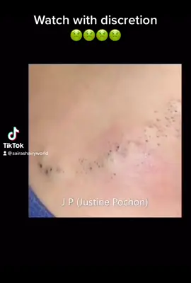 TikTok plse don’t block my video. #badskinproblems #acne #pimplepop #extractions #verymessy #popping #viralvideo #foryoupage 