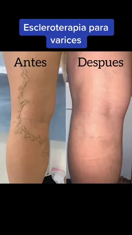 Escleroterapia para varices. Toda varice tiene un tratmiento. 🤩