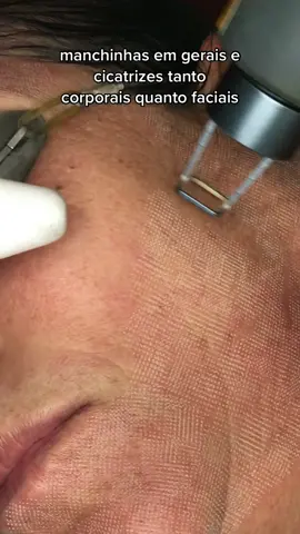 Laser de co2 fracionado #estetica #limpezadepele #laserdeco2  #laserdeco2fracionado  #laser #lasererbium #niquelandiago #anapolis 