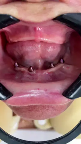 Emtrega de protocolos sobre 4 implantes todos os dias (All-On-4). #natalrnbrazil #implantodontia #brasil #natalrn🇧🇷 #implantesdentarios #dentistry #protesesobreimplantes #prótese #implantes #odontologia #odonto 