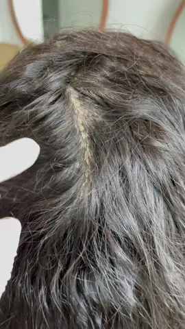 Isso é real, muito real. Caso clínico da minha paciente, diagnosticada pelo dermatologista como dermatite seborreica, essa patologia de couro cabeludo já acompanha minha paciente desde da infância.  Agora com a terapia capilar ela consegue ter uma qualidade de vida capilar equilibrada.  Mas não se estende só ao cuidado da terapia capilar, tratamento de couro cabeludo é multidisciplinar, é necessário total consciência do paciente e muitas vezes a intervenção de outros profissionais como dermatologistas, psicólogos, nutricionista, atividades físicas, para resultados mais satisfatórios. #dermatitisseborreica #patologiadocourocabeludo #doencascourocabeludo 