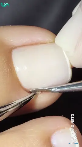 71.TK.CORTOU ERRADO E FICOU AQUELE PEDACINHO #unhaencravadas  #nail  #podologomaurelio  #ingrowntoenail  #ingrowntoenailremoval