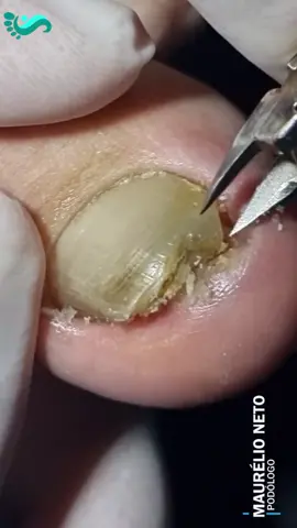 77.TK.FUNGO & UNHA ENCRAVADA #unhaencravadas  #nail  #podologomaurelio  #ingrowntoenail  #ingrowntoenailremoval