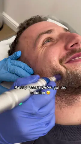 Patchy beard? Bald spots? We've got the solution for you! ☺️ #misotherapy #microneedling #microneedlingtherapy #hairhrowth #hairgrowthjourney #beautyadvancecardiff 
