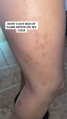 BYE SPOTS! Let’s get back to the basics! Must have routine to get rid of dark spots! I’ll share all my tips! ❤️ #darkspots#skincare #hyperpigmentation 