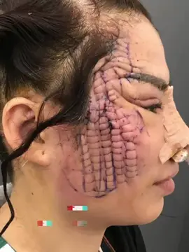 Mấy bà dám thẩm mỹ như vậy để đẹp hong? Đúng nhận sai cãi liền 😌 #thammy #damat #căngdamặt #xuhuong #fyb #phauthuatthammy 