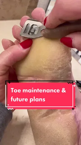 Toe maintensnce while discussing a new experiment I’ll be doing on my feet coming up! @parmesanpalms this links to the video about the cream I’ll be trying ❤️ #parmeseanpalms #callusedfeet #footcallus #callousedfoot #palmoplantarkeratoderma #ppkawareness #raredisease #rareskincondition #eppk #dermatologytiktok #podiatry #hyperkeratosis #callous #keratoderma #pedicuretools #podiatrylife #callousedfeet #toes #skinresurfacing #keratolytic #keratolyt5 ##epidermisremoval