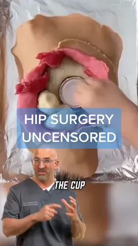 Hip Replacement Uncensored #totalhip #hipsurgery #hipreplacementsuccess #futuresurgeons 