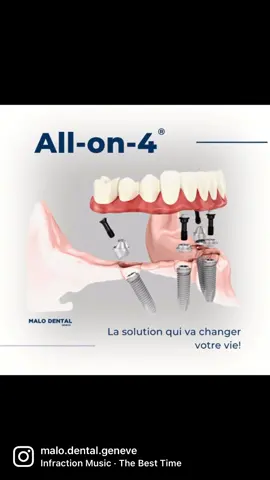 Découvrez l'innovante méthode de réhabilitation immédiate totale sur implants  All-on-4® !🦷 Le traitement All-on-4® propose une restauration complète des dents pour les patients édentés et ne nécessite que 4 implants dentaires pour soutenir une prothèse complète.🤩 Ce traitement est idéal pour les personnes ayant une masse osseuse trop faible pour les implants traditionnels. Grâce au protocole All-on-4®, les patients édentés peuvent profiter d’une nouvelle dentition sans avoir besoin de recours à la greffe osseuse. Afin de savoir si vous êtes un bon candidat à la technique All-on-4® ou pour plus d’information, prenez rendez-vous avec un de nos spécialistes pour une consultation.👇 ☎️ +41 22 346 68 76 📍Rue Emile-Yung 11, 1205 Genève 📧 cabinetdentairedrmartins@gmail.com 💻 www.malodentalgeneve.com #malodentalgeneve #malodental #bestdentalclinic #allonfour #allon4 #nobelbiocare #dentalimplants #samedayteeth 
