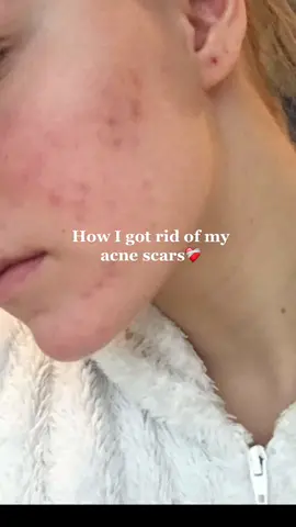 Love these products❤️‍🩹 #acnescarserums #hyperpigmentationserum #skin1004centellasuncreamplus #spfeverydamnday #getridofacnescars 