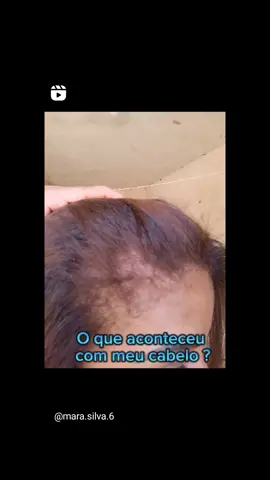 Tive uma queda de cabelo nas laterais, o processo foi longo, mas ele está se desenvolvendo a cada dia, cuidar e ter paciência, esse é o segredo. #foco #cabelo #dicas 