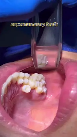A supernumerary tooth is an extra tooth. Typically, humans have sets of 20 baby teeth and 32 permanent teeth (assuming all four wisdom teeth develop), as shown in the diagrams below. If a person has one or more teeth that are additional to these typical sets of teeth, the person is said to have hyperdontia, and the additional teeth are known as supernumerary teeth.#Dentistry #Tooth #teeth 