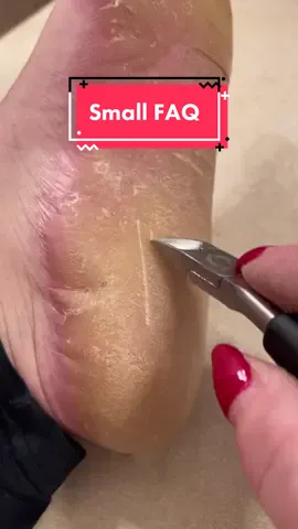 Replying to @samandcobly74 Quick FAQ 😁 Stick around to see me scratch the shit out of my skin 😅😅 #skinpicking #parmeseanpalms #dermotillomania #ppkawareness #foot #footcallus #footcallusremoval #callusedfeet #callused #callous #palmoplantarkeratoderma #raredisease #rareskincondition #eppk #dermatologytiktok #podiatry #hyperkeratosis #keratoderma #ocdanxiety #faq #dermatophagia #ocdanxiety #epidermolytichyperkeratosis #footpeelingmask #footpeelmask 