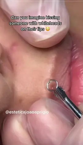 #lip #whiteheads #extractions #lipcare #usa #france #morroco #albania #foryoupage 