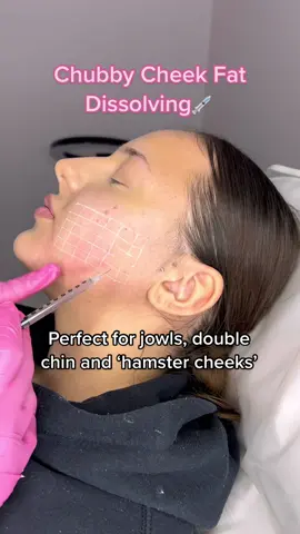 ⚠️ Needles - Get rid of those ‘hamster cheeks’ with our fat dissolving injections today💉 🐹  #chubbycheeks #fatdissolving #contouring #slimface 