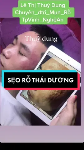 #sẹorỗ thái dương có bạn nào bị như khách nhà Dung không nhỉ ??? #lêthithuydung616 #chuyên_đtri_mụn_rỗ_tpvinh_nghệan #mdspa_chuyên_mụn_rỗ_tpvinh 
