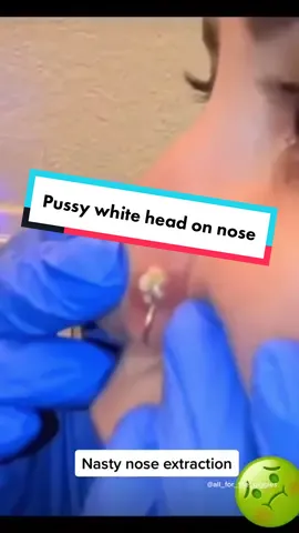 Nasty nose exttaction. #cyst #cystpopping #dilatedpore #satisfyingvideo #zitpoppingvideos #drpimplepopper #blackheads 