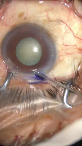 Mais um caso de cegueira reversivel! 🥰 #catarata #refrativa #oftalmologia #ophtalmology #cataract #prk #lasik 