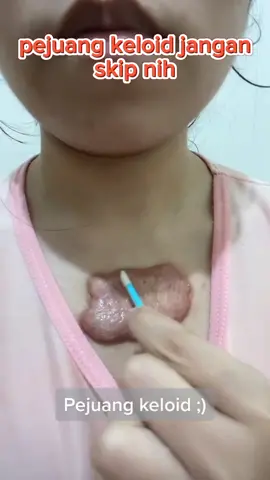 Keloid bisa teratasi dengan satu produk aja#bekasluka #keloid #scar #lotion #skincare #luka 