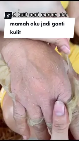 Mamah aku jadi ganti kulit 